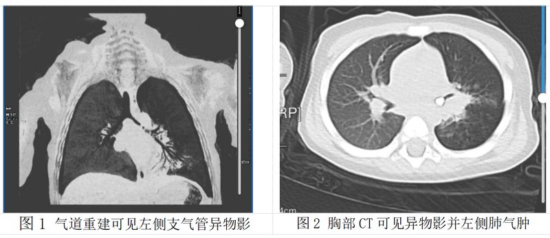 宝宝气道惊魂:一颗乳牙滞留五十天,险酿大祸;春节临近,家长如何筑牢防护墙。 健康养生