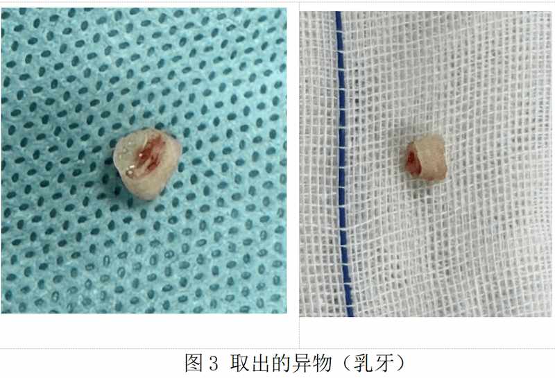 宝宝气道惊魂:一颗乳牙滞留五十天,险酿大祸;春节临近,家长如何筑牢防护墙。 健康养生