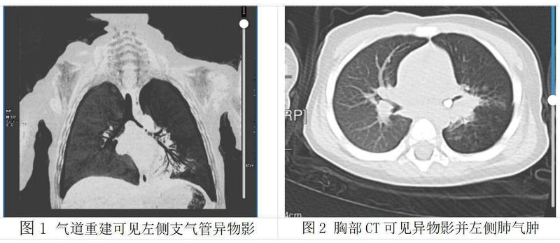 宝宝气道惊魂:一颗乳牙滞留五十天,险酿大祸;春节临近,家长如何筑牢防护墙。 健康养生