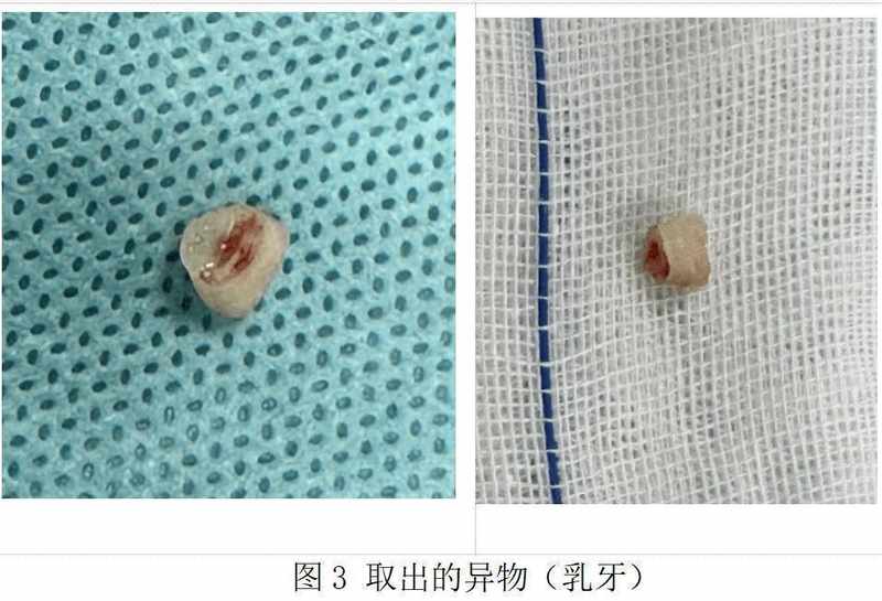 宝宝气道惊魂:一颗乳牙滞留五十天,险酿大祸;春节临近,家长如何筑牢防护墙。 健康养生