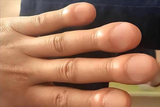  从影像科到临床：肺癌五大非典型信号的技术拆解与实战筛查 健康养生