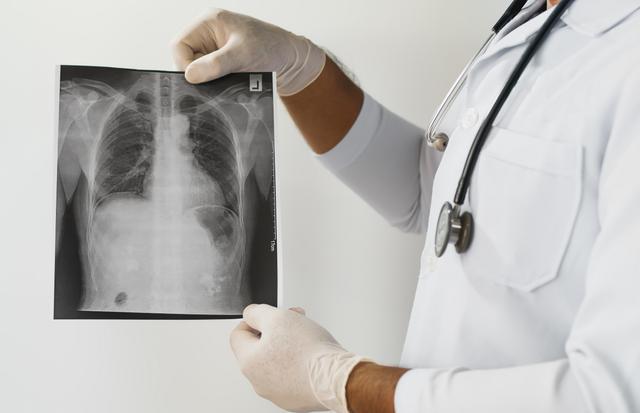  从影像科到临床：肺癌五大非典型信号的技术拆解与实战筛查 健康养生